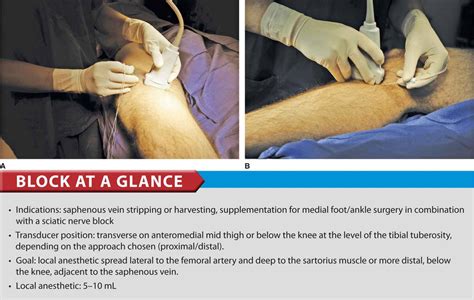 Ultrasound-Guided Saphenous Nerve Block - Hadzic's Peripheral Nerve Blocks and Anatomy for ...