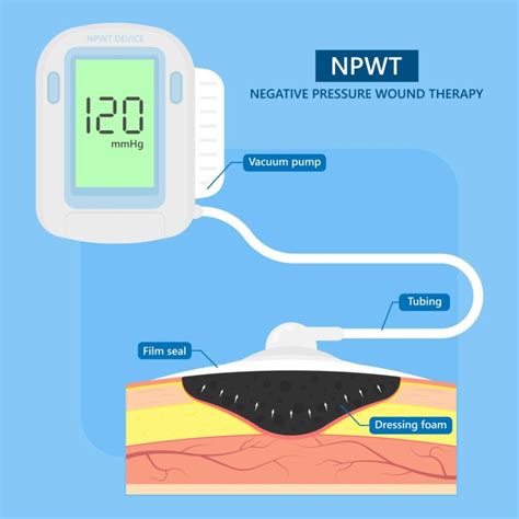 Negative Pressure Wound Therapy (NPWT) Device - Gilero