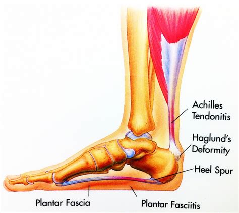 Heel Spur Syndrome | Foot & Ankle Doctors, Inc.