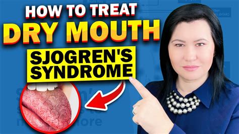 Sjogren's Syndrome: Dry Mouth Treatment Options - YouTube