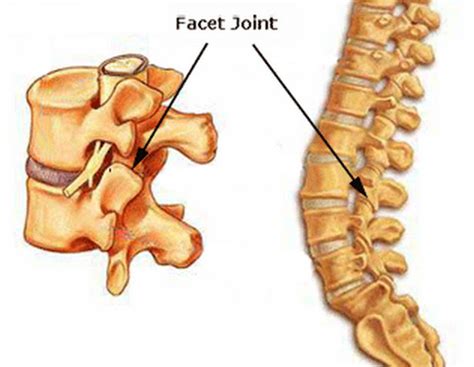 Facet Arthropathy Types, Causes, Diagnosis, Treatment, Surgery