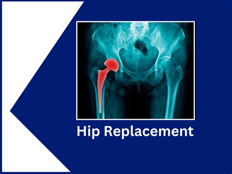 Best Hip Replacement Surgery In India | EdhaCare | by shaym kumar | Medium