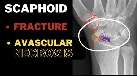 Anatomical Snuff box (Part 2) Scaphoid - Fracture; AVN | In 3 MINUTES - YouTube