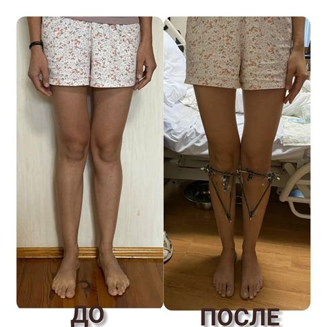 knock knee before and after surgery | Knock knees, Genu valgum, Knock knees correction