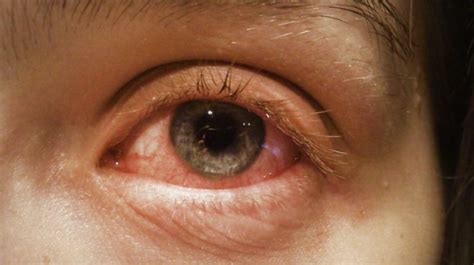 Common Eye Infections: Causes And Symptoms I Lustereyes