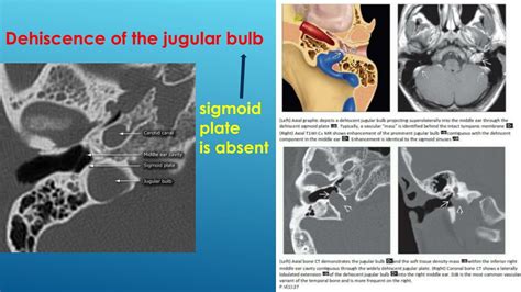 PPT - Jugular bulb abnormalities PowerPoint Presentation, free download - ID:685395