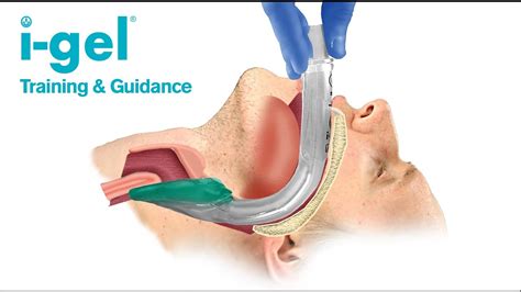 i-gel® supraglottic airway from Intersurgical: an introduction - YouTube