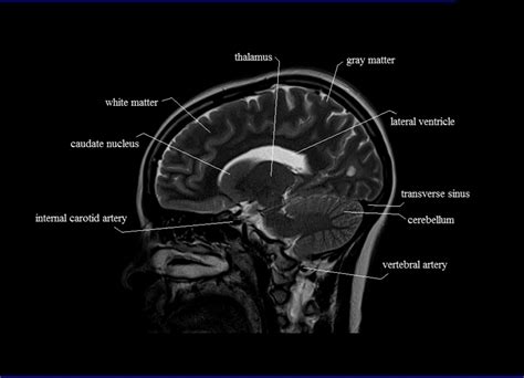 Cross Sectional Anatomy | MRI Brain Sagittal Anatomy | Free MRI brain Cross Sectional Anatomy