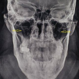 Computed tomography (CT) image reconstruction of the neck (frontal,... | Download Scientific Diagram