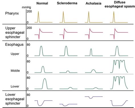 esophageal manometry interpretation : r/step1