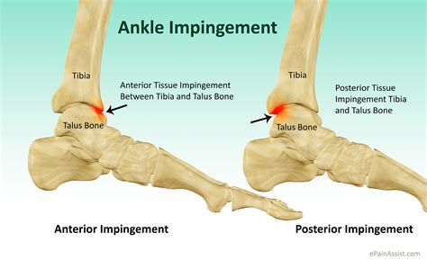 Anterior Ankle Impingement - Book In At Podiatry HQ Clinics Today!