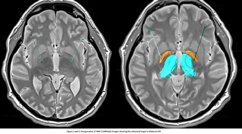 Successful treatment of secondary dystonia with deep brain stimulation of the globus pallidus ...