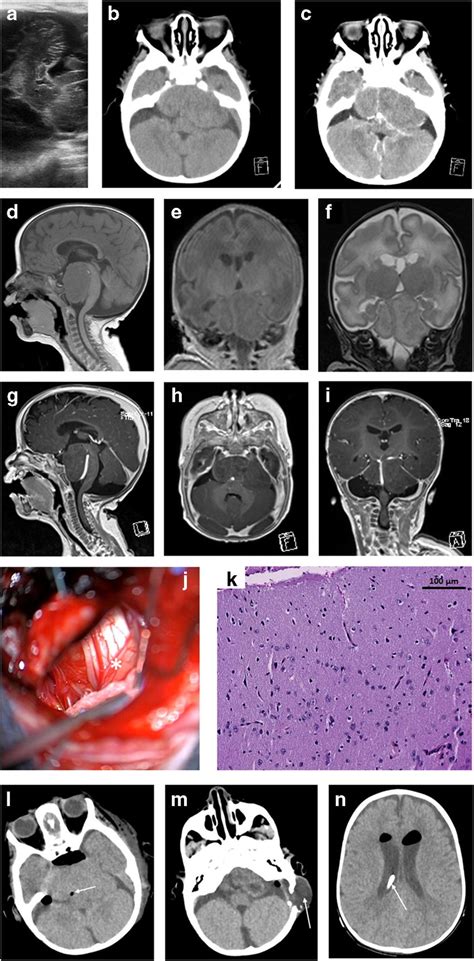 Giant hypothalamic hamartoma in trans-anterior fontanel US (a), in CT ...