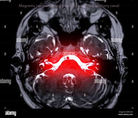 MRI Brain scan with the internal auditory canal (IAC) axial view Stock Photo - Alamy