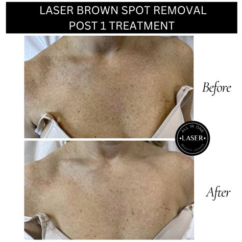 LASER BROWN SPOT REMOVAL — ALL IN ONE LASER