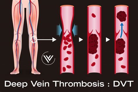 Are Superficial Thrombophlebitis and Deep Vein Thrombosis Treated the Same Way?: Center for ...