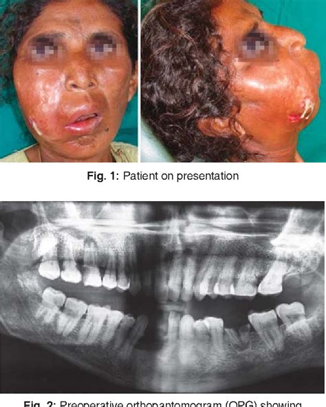 Necrotizing Fasciitis of Face in Odontogenic Infection: A Rare Clinical ...