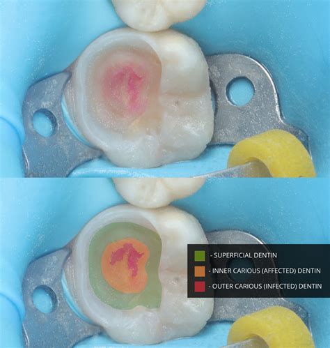 Lesson 3 - Immediate Dentin Sealing (IDS) and Resin Coating (RC) - The Hybrid Layer