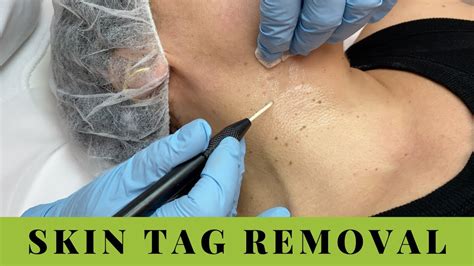 Skin Tags Removal on Neck and Underarms. Quick, easy, no pain. - YouTube