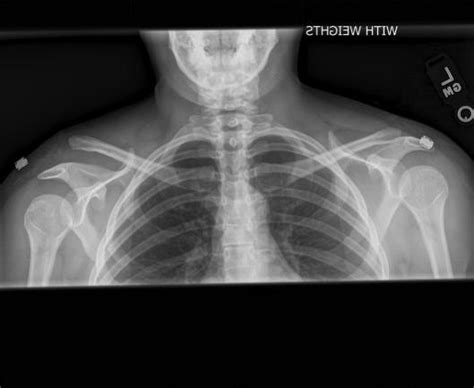 Surgery for a shoulder separation | Dr. David Geier - Sports Medicine Simplified