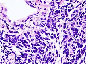 Small cell carcinoma of the lung - Libre Pathology