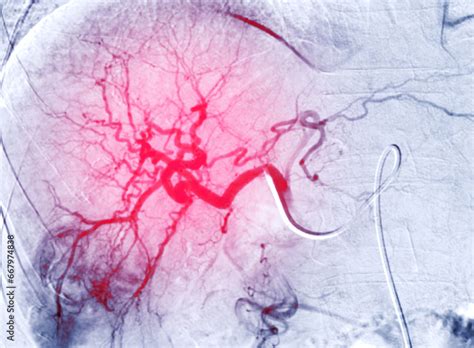 Transarterial Chemoembolization (TACE) is a medical procedure used to the treatment of ...