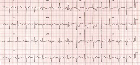 ECG interpretation questions in the CICM Fellowship Exam | Deranged Physiology