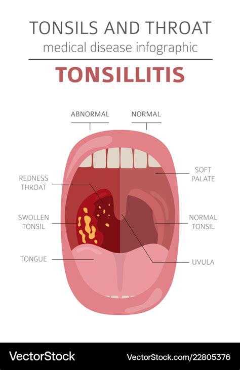 Tonsillitis antibiotics nhs