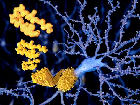 Alzheimer's-linked Buildup of Amyloid Beta More Common Than Thought, Study Finds - Alzheimer's ...