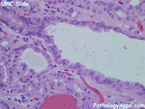 Fundic Gland Polyp Histology