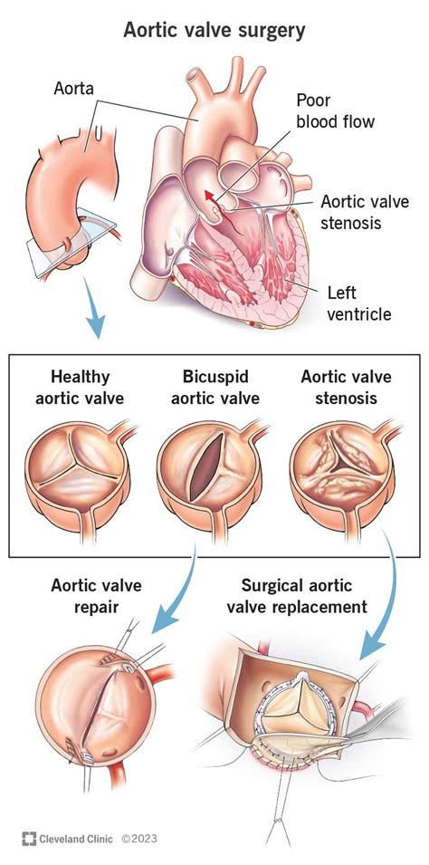 Aortic Valve Surgery: Procedure Details & Benefits