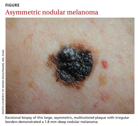 Melanoma: An FP’s guide to diagnosis and management | MDedge Family Medicine