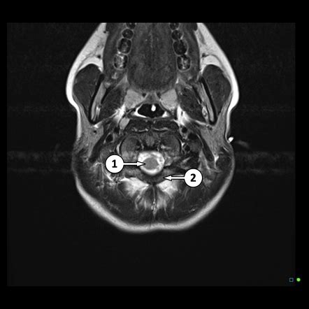 Axial Head Mri Scan