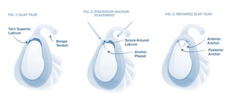 Shoulder Labrum Surgery Recovery: How Successful is Shoulder Labrum ...