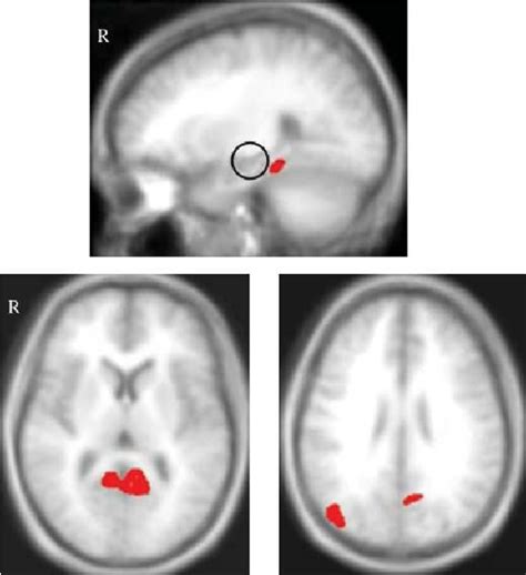 Brain regions activated in the comparison of all remote spatial memory ...