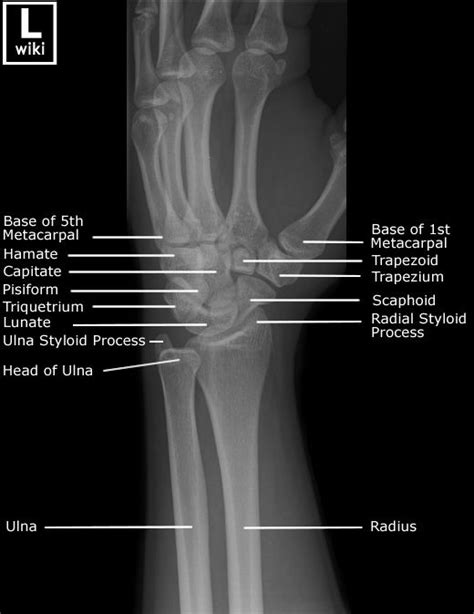 Wrist Radiographic Anatomy - wikiRadiography | Radiology student ...