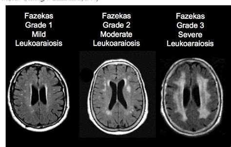 [PDF] Diminished cerebrovascular reserve in the cerebral white matter of elderly individuals ...