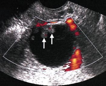 Masa pélvica femenina - Ginecología y obstetricia - Manual MSD versión para profesionales