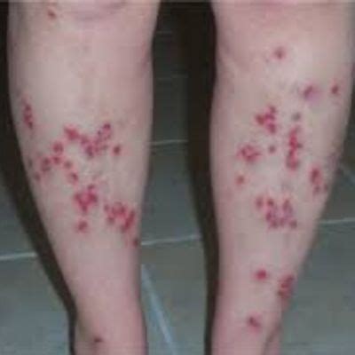 Symptoms Stages Of Morgellons Disease Pictures