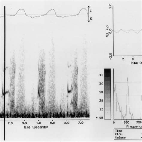 (PDF) Respiratory Sounds: Advances Beyond the Stethoscope