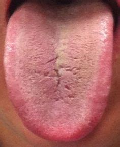 Tongue cracks - what do they say about your health? Healthy Tongue, Tongue Health, Healthy ...