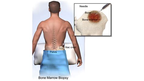 Bone Marrow Aspiration & Biopsy