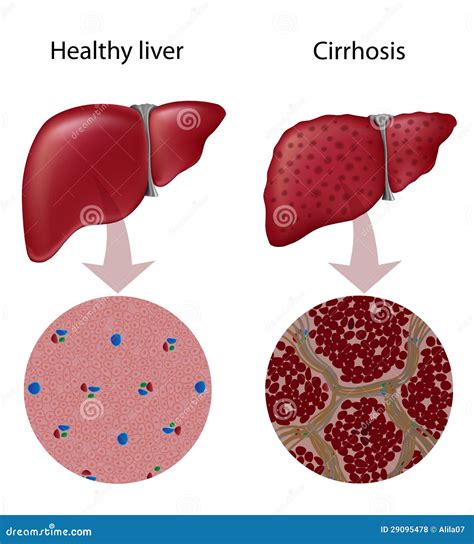 Liver Cirrhosis Royalty Free Stock Photos - Image: 29095478