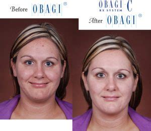 Obagi® Before and After Pictures – Micki Ly M.D. Maui Dermatologist