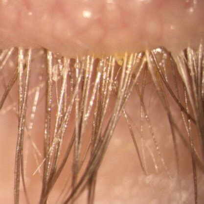 example of a patient with Demodex folliculorum. Note the cylindrical ...