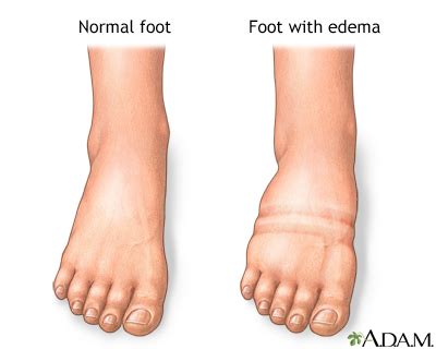 Foot swelling: MedlinePlus Medical Encyclopedia Image