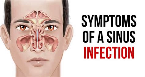 Signs And Symptoms Of Sinus Infection-prlog