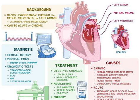 Mitral regurgitation - MEDizzy