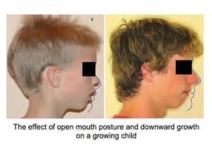 Mouth Breather Face-What Causes it and How to Fix it