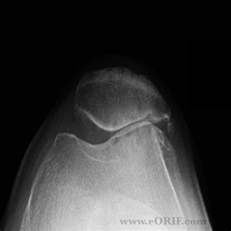 Patellofemoral Arthritis Images | eORIF